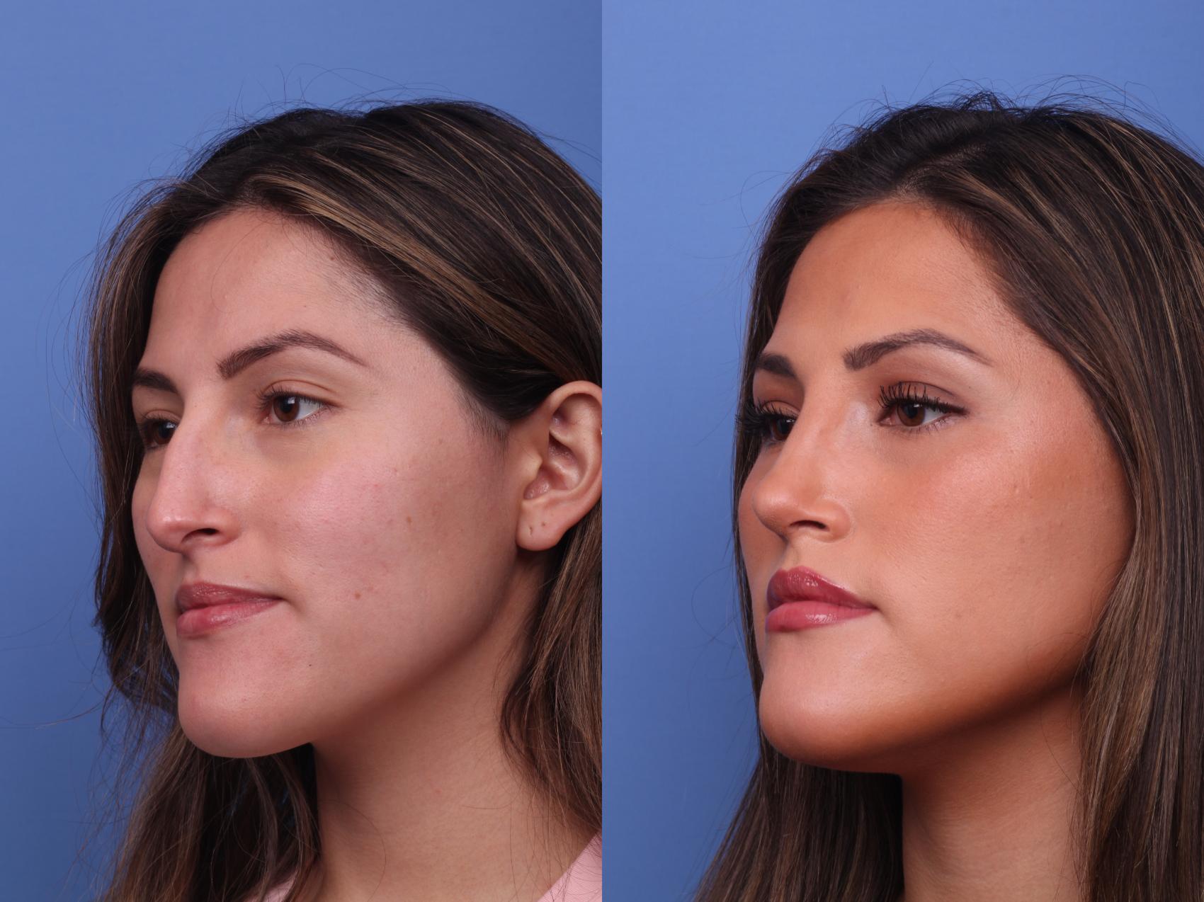 Before & After Rhinoplasty Case 382 Left Oblique View in Scottsdale, AZ