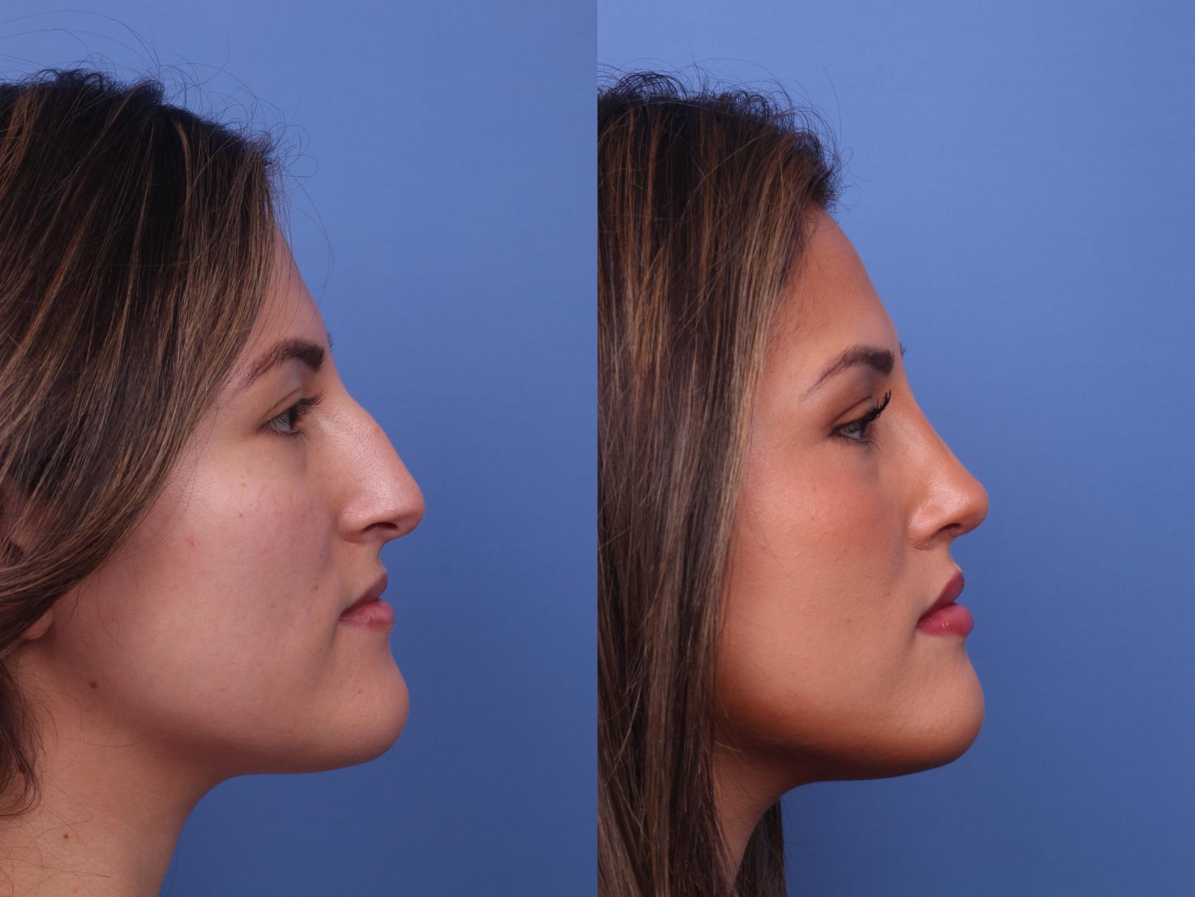 Before & After Rhinoplasty Case 382 Right Side View in Scottsdale, AZ