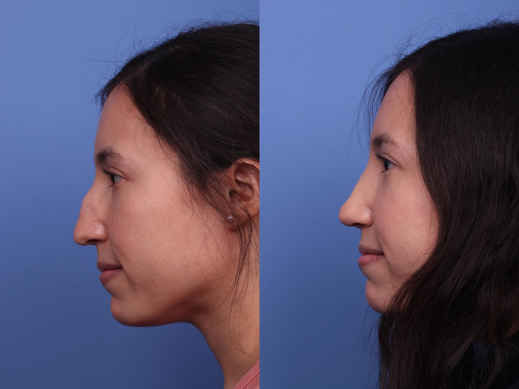 Before & After Rhinoplasty Case 383 Left Side View in Scottsdale, AZ
