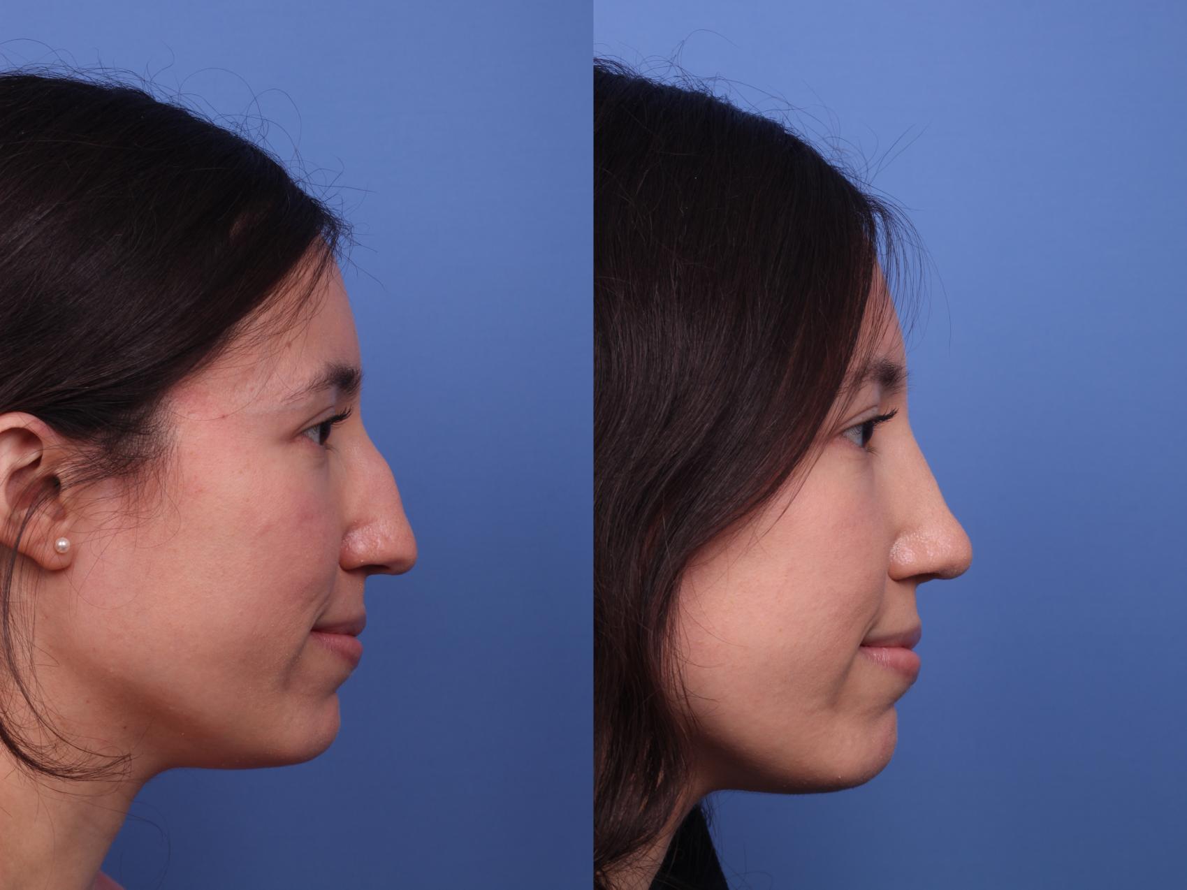 Before & After Rhinoplasty Case 383 Right Side View in Scottsdale, AZ