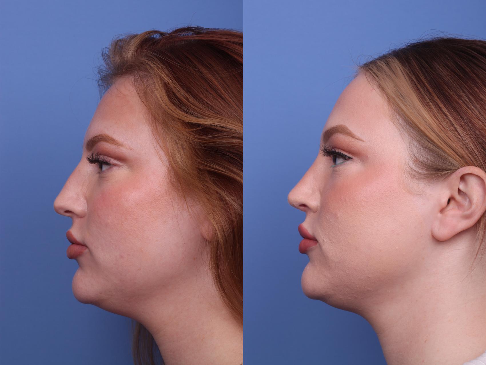 Before & After Rhinoplasty Case 388 Left Side View in Scottsdale, AZ