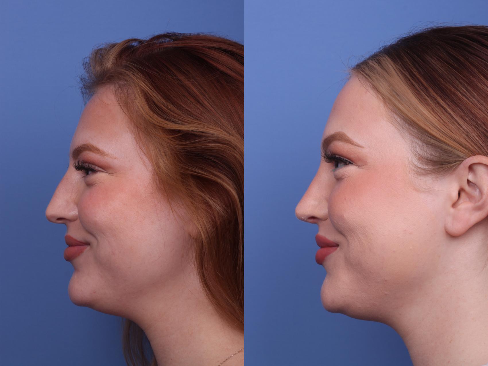 Before & After Rhinoplasty Case 388 Left Smile View in Scottsdale, AZ