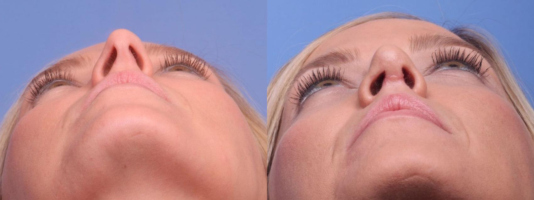 Before & After Rhinoplasty Case 39 View #1 View in Scottsdale, AZ