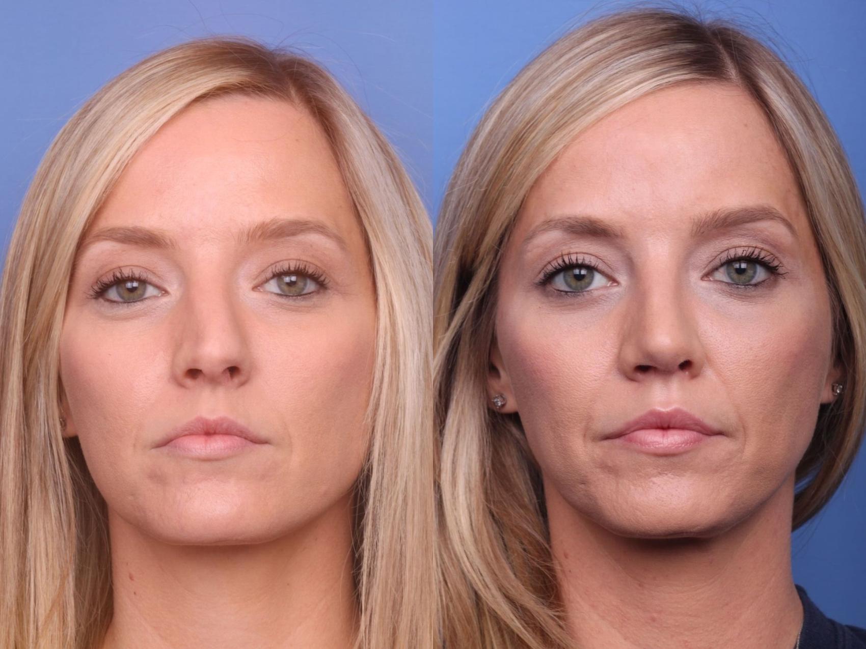 Before & After Rhinoplasty Case 39 View #2 View in Scottsdale, AZ