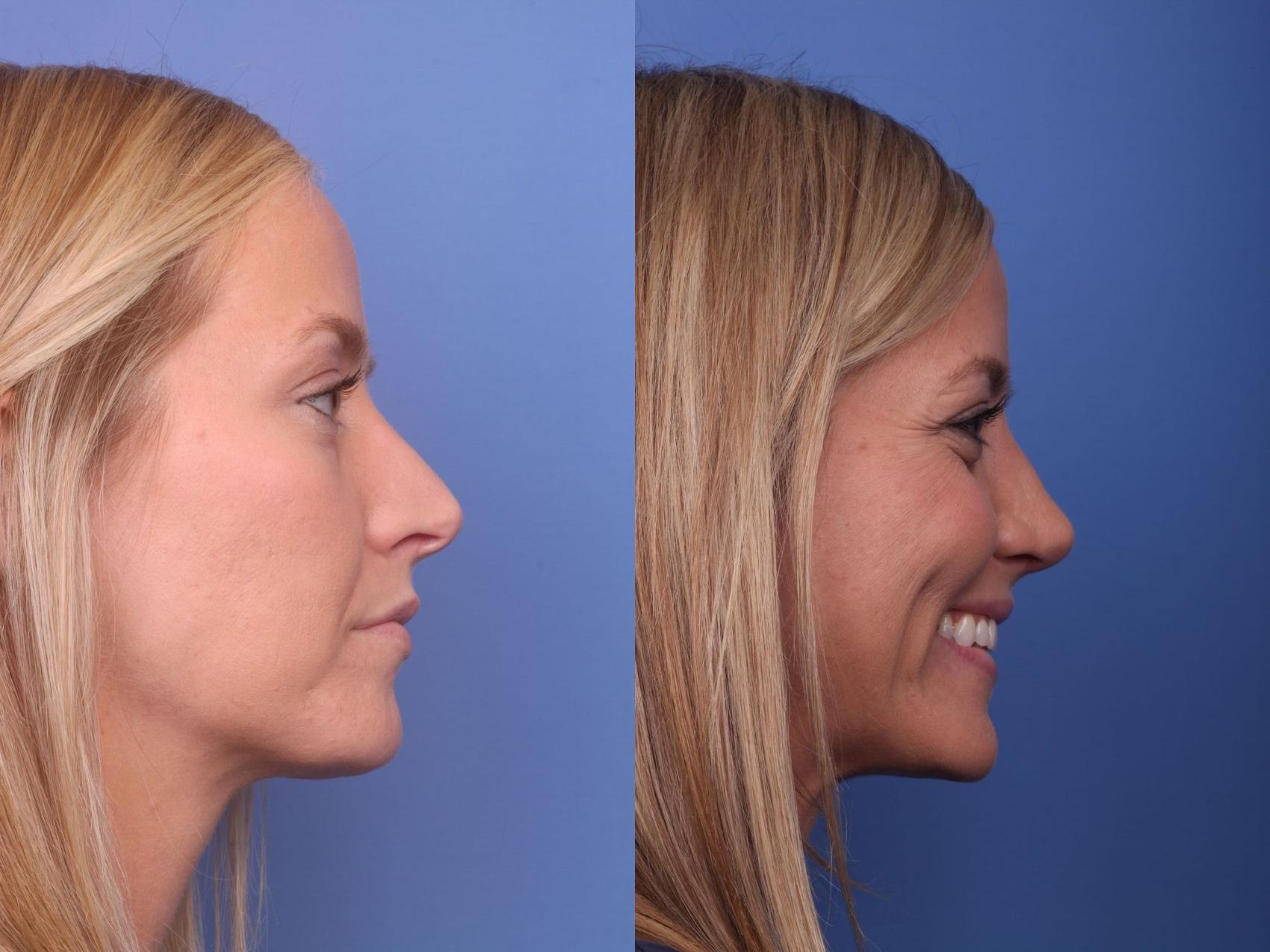 Before & After Rhinoplasty Case 39 View #4 View in Scottsdale, AZ