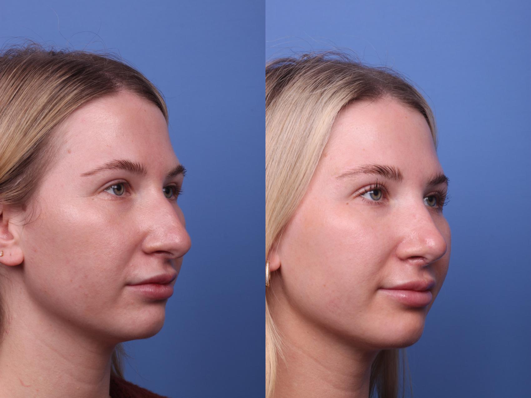 Before & After Rhinoplasty Case 392 Right Oblique View in Scottsdale, AZ