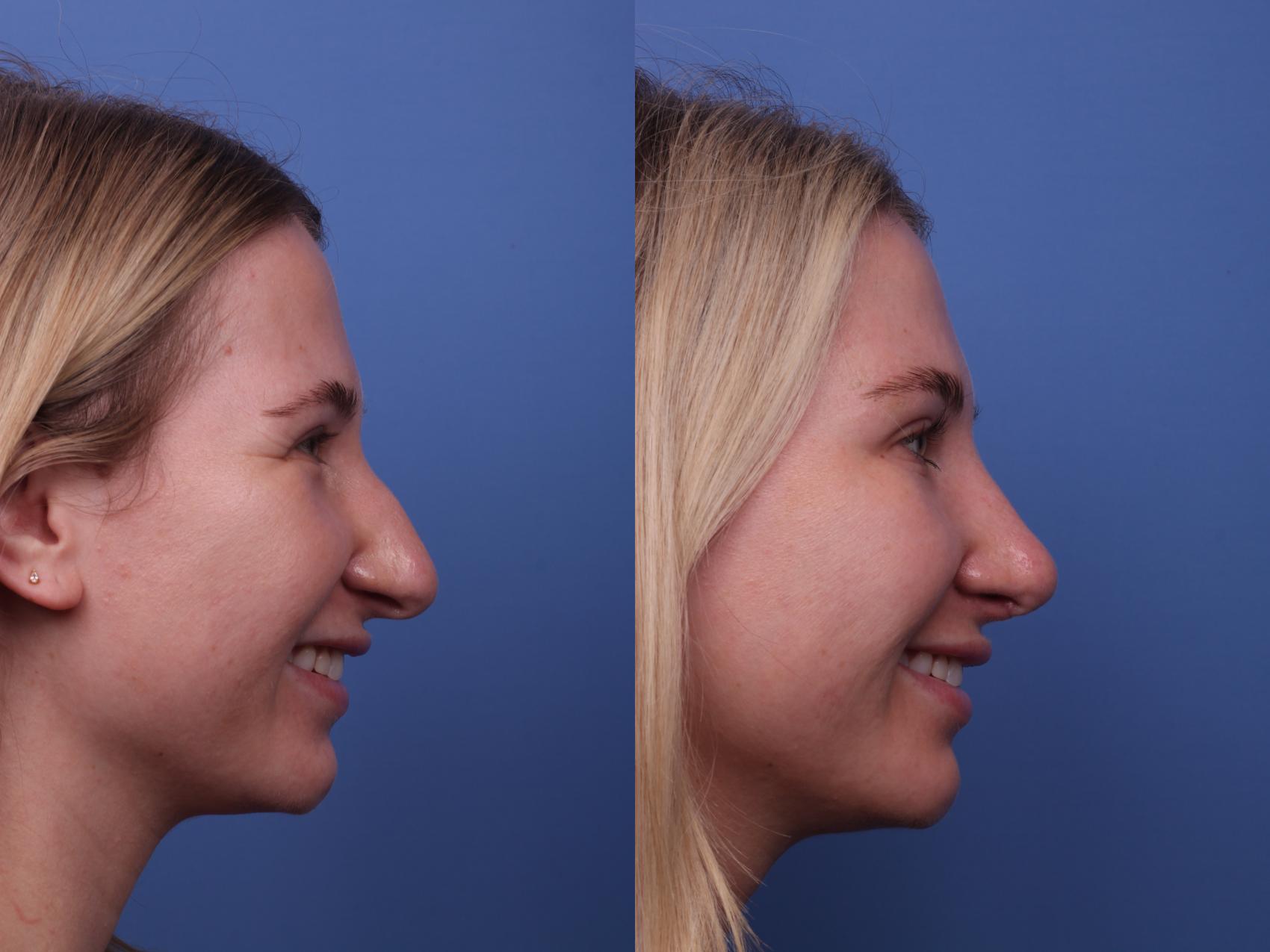 Before & After Rhinoplasty Case 392 Right Smile View in Scottsdale, AZ