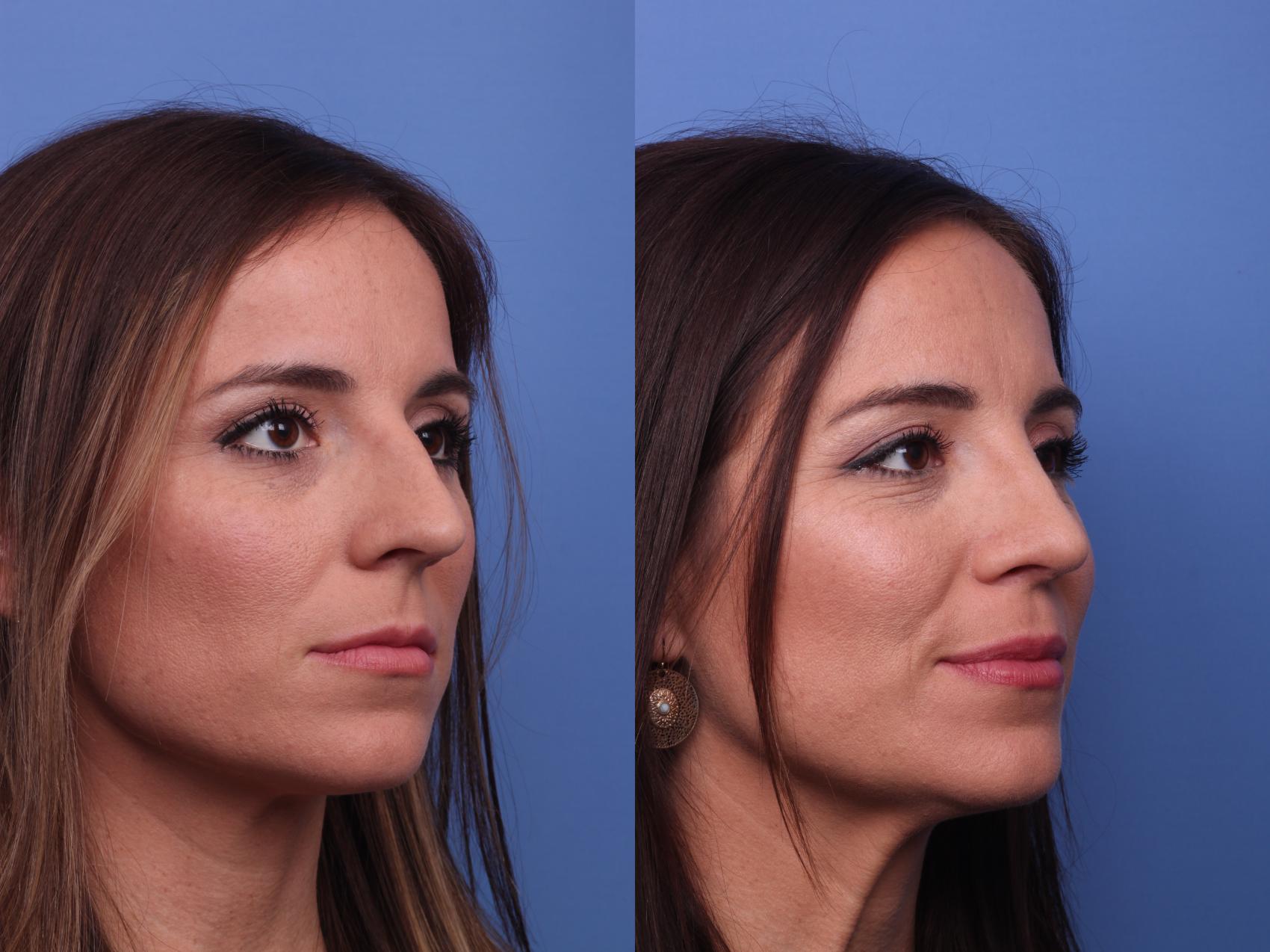 Before & After Rhinoplasty Case 393 Right Oblique View in Scottsdale, AZ