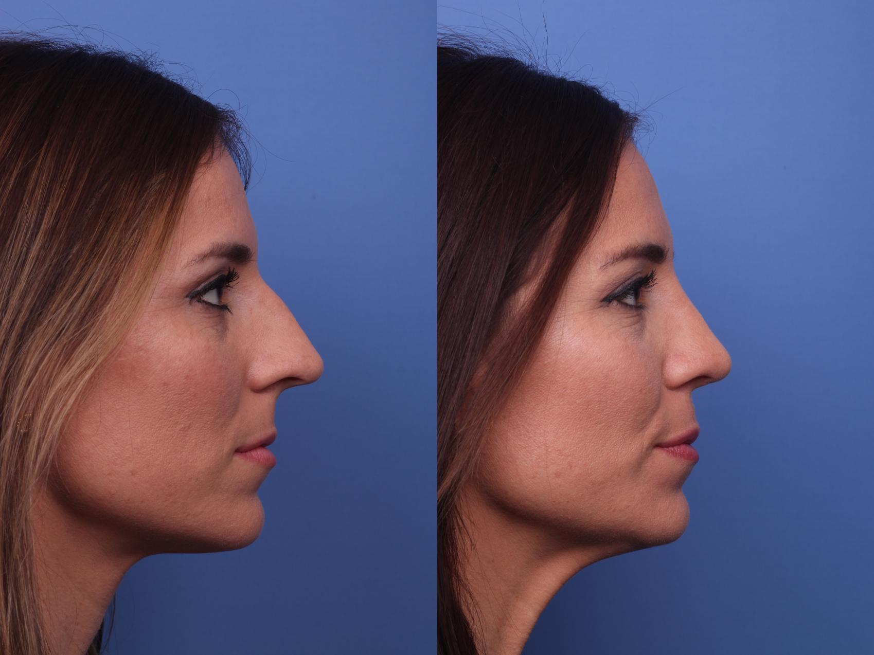 Before & After Rhinoplasty Case 393 Right Side View in Scottsdale, AZ