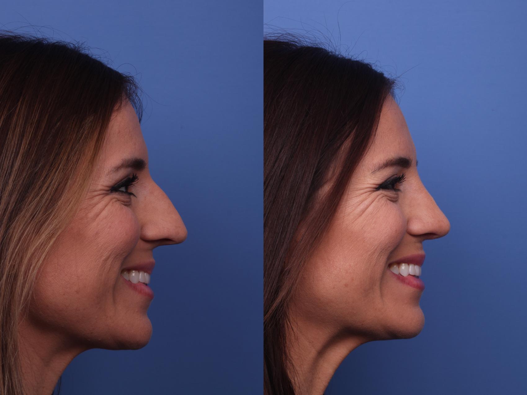 Before & After Rhinoplasty Case 393 Right Smile View in Scottsdale, AZ