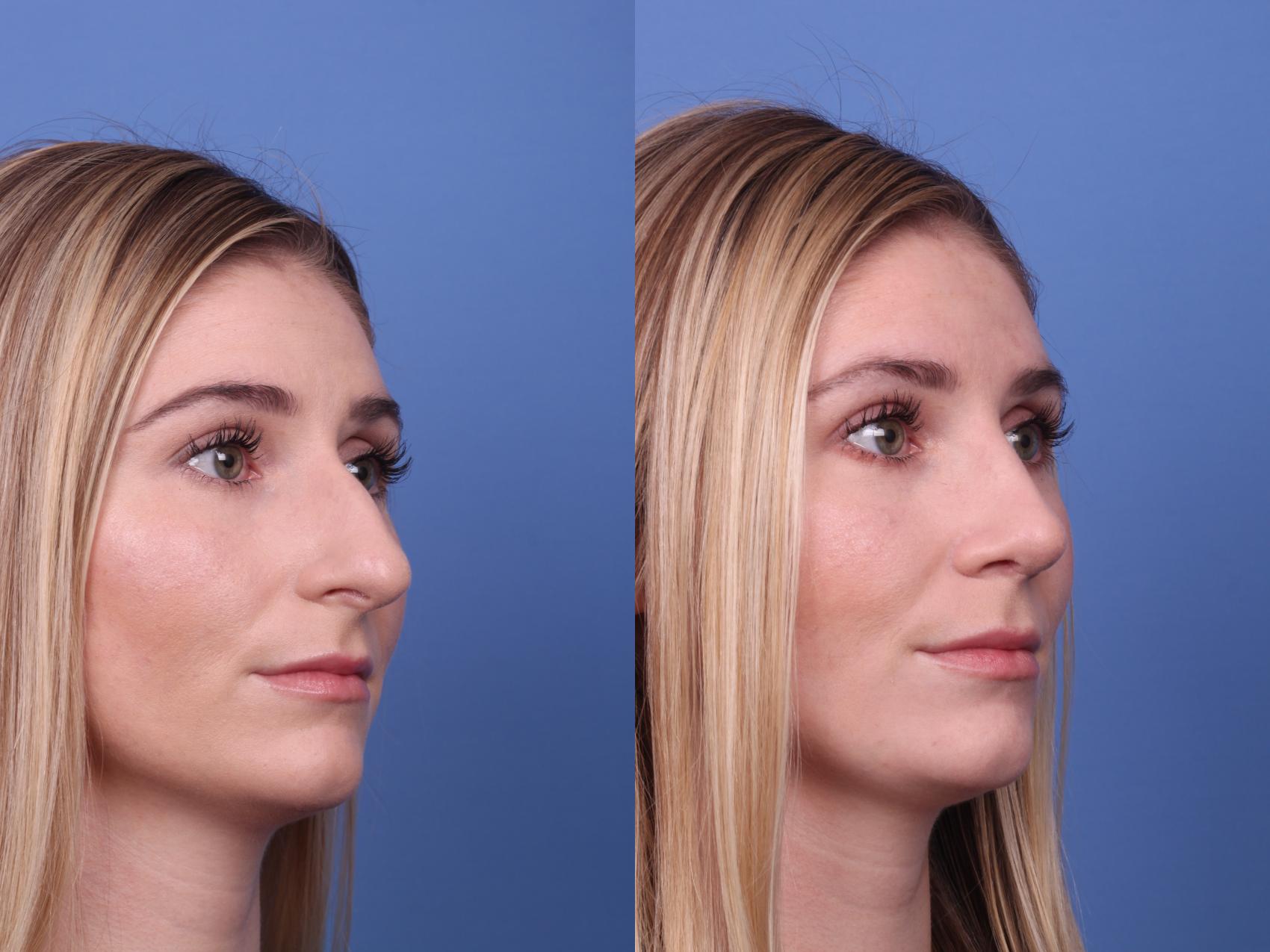 Before & After Rhinoplasty Case 394 Right Oblique View in Scottsdale, AZ