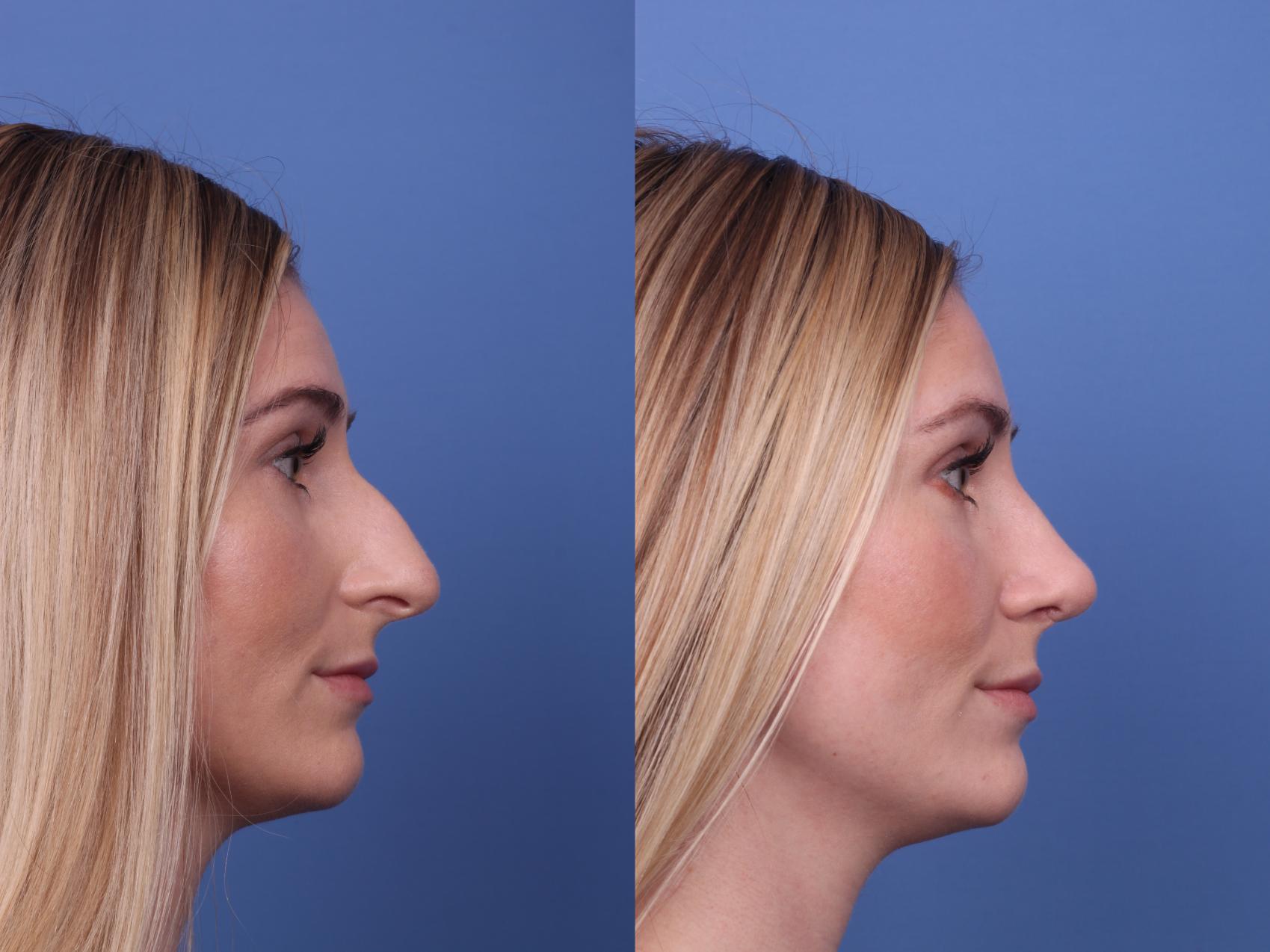 Before & After Rhinoplasty Case 394 Right Side View in Scottsdale, AZ