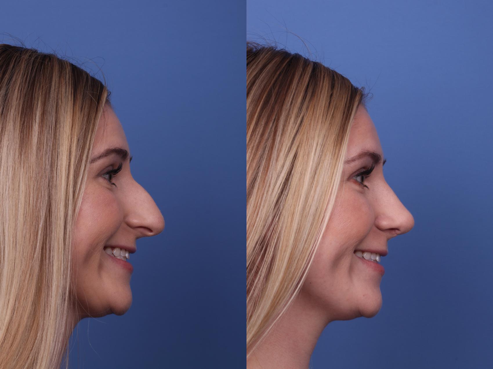 Before & After Rhinoplasty Case 394 Right Smile View in Scottsdale, AZ