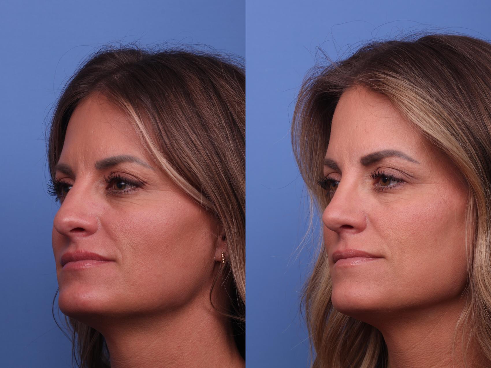 Before & After Rhinoplasty Case 395 Left Oblique View in Scottsdale, AZ