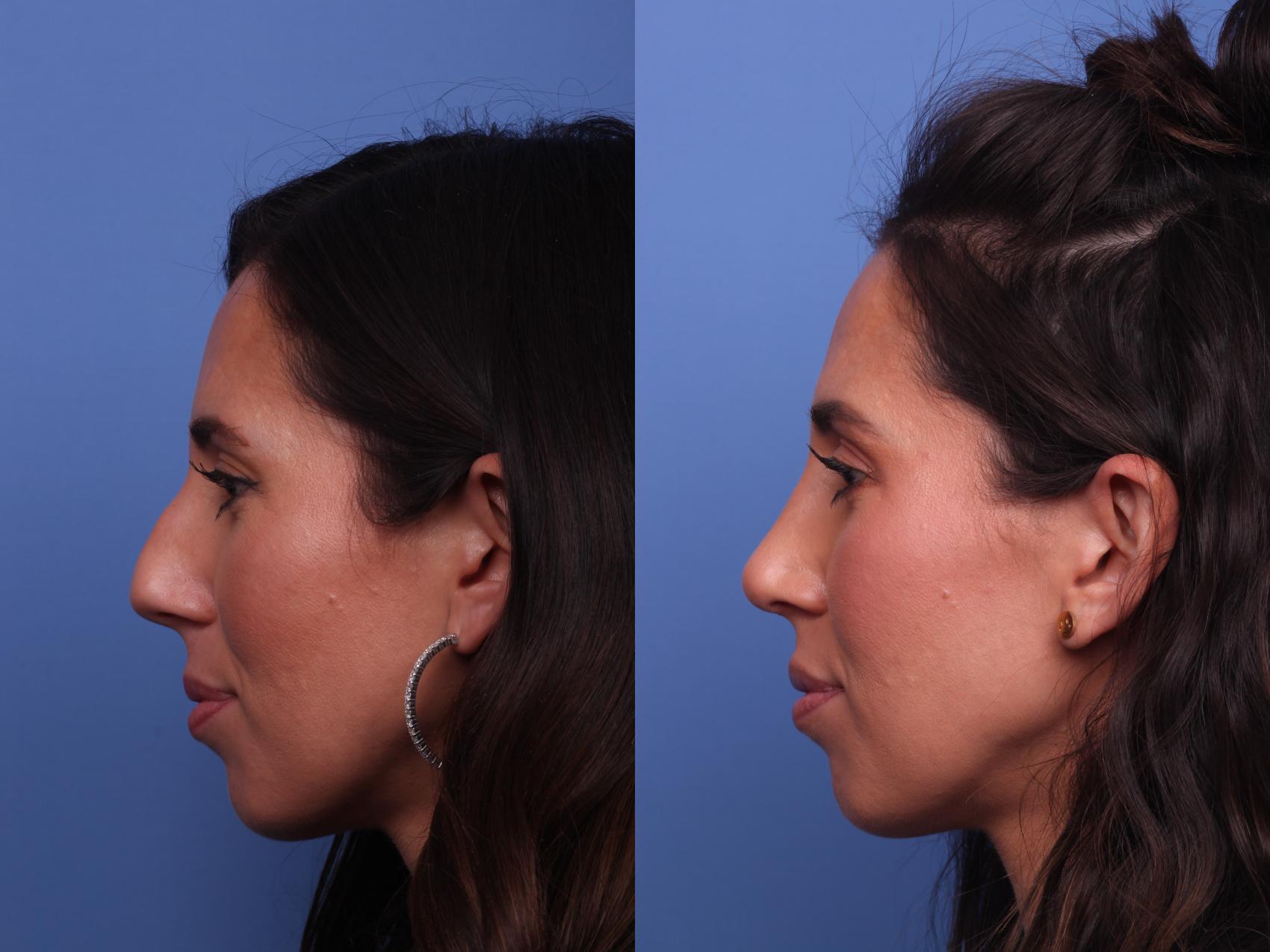 Before & After Rhinoplasty Case 396 Left Side View in Scottsdale, AZ