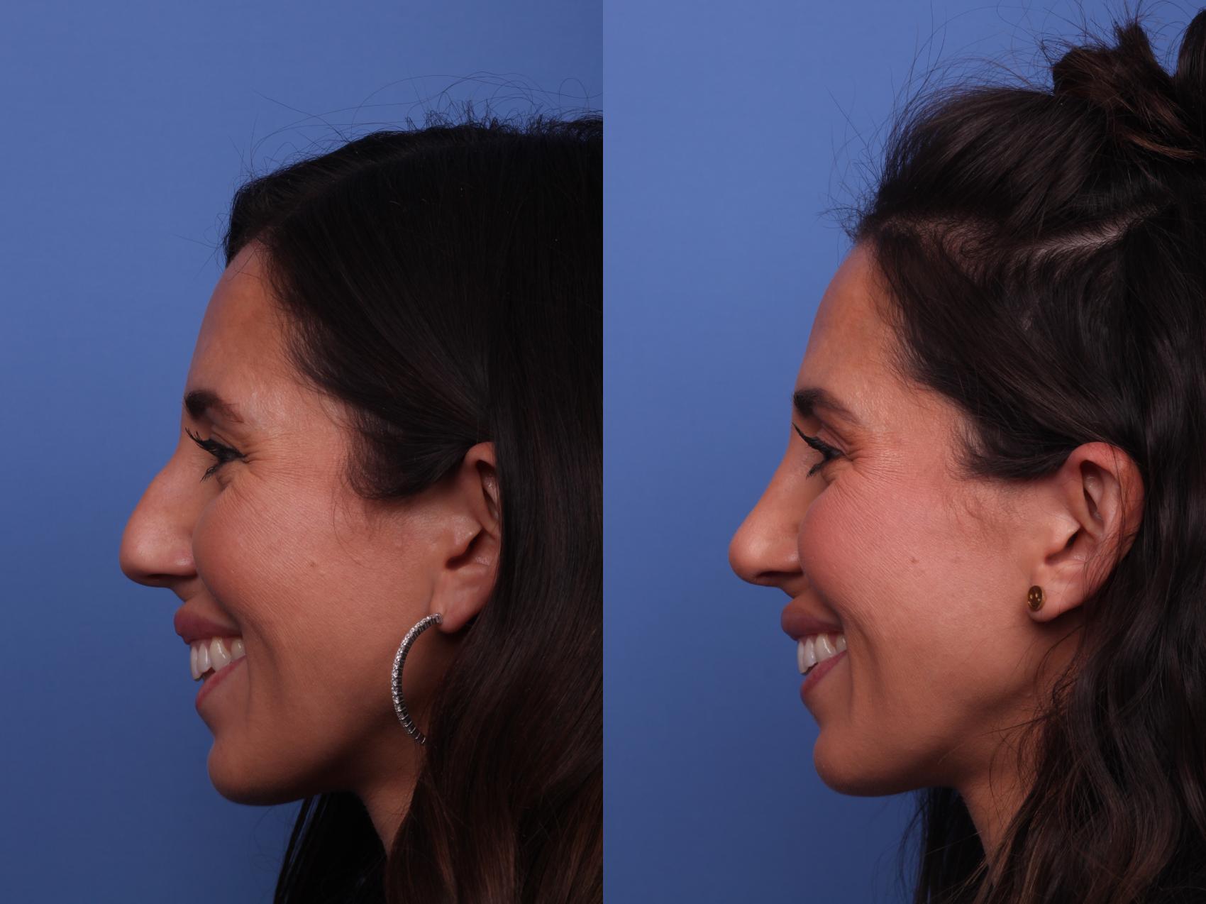 Before & After Rhinoplasty Case 396 Left Smile View in Scottsdale, AZ