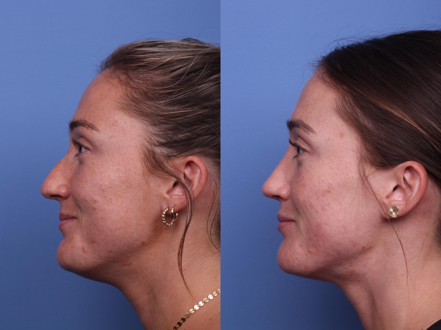 Before & After Rhinoplasty Case 397 Left Side View in Scottsdale, AZ