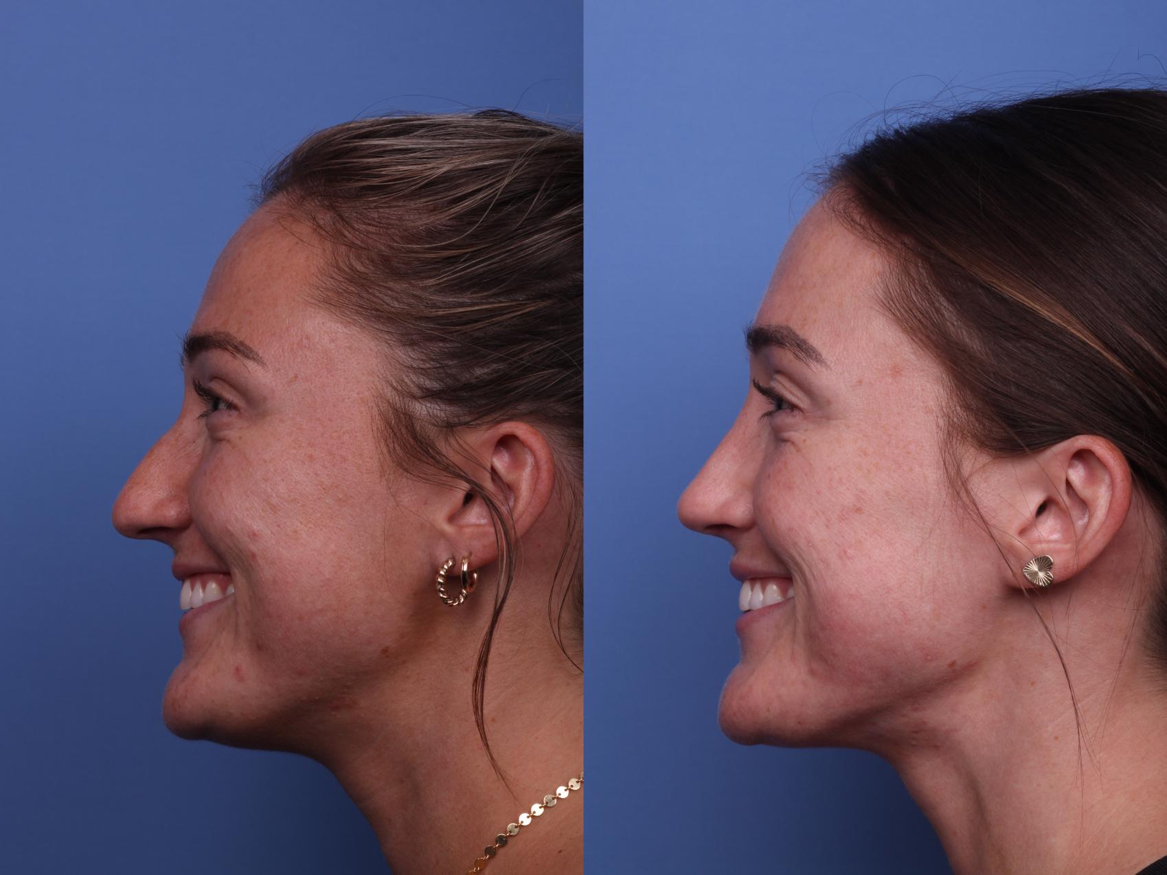 Before & After Rhinoplasty Case 397 Left Smile View in Scottsdale, AZ