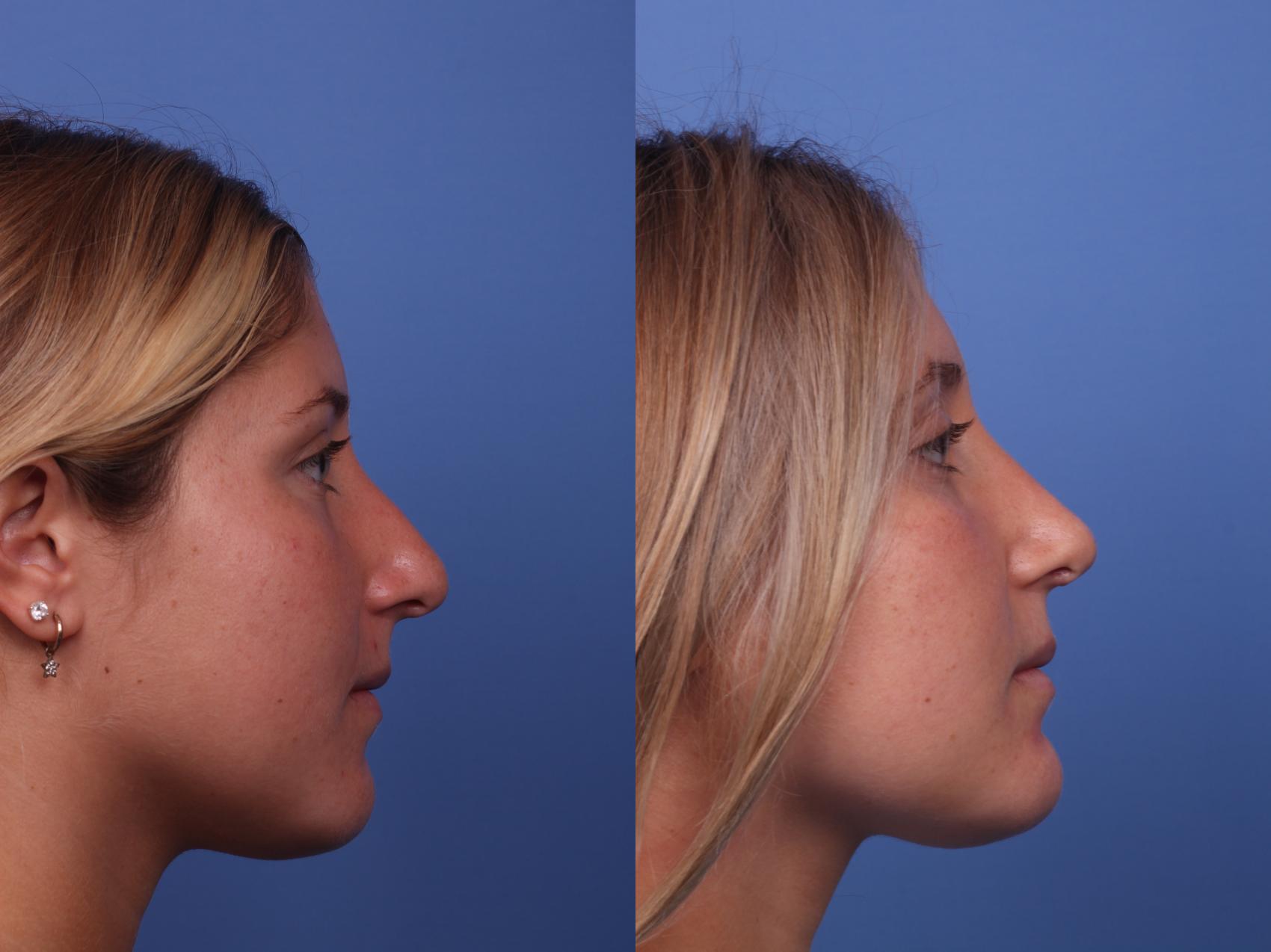 Before & After Rhinoplasty Case 398 Right Side View in Scottsdale, AZ