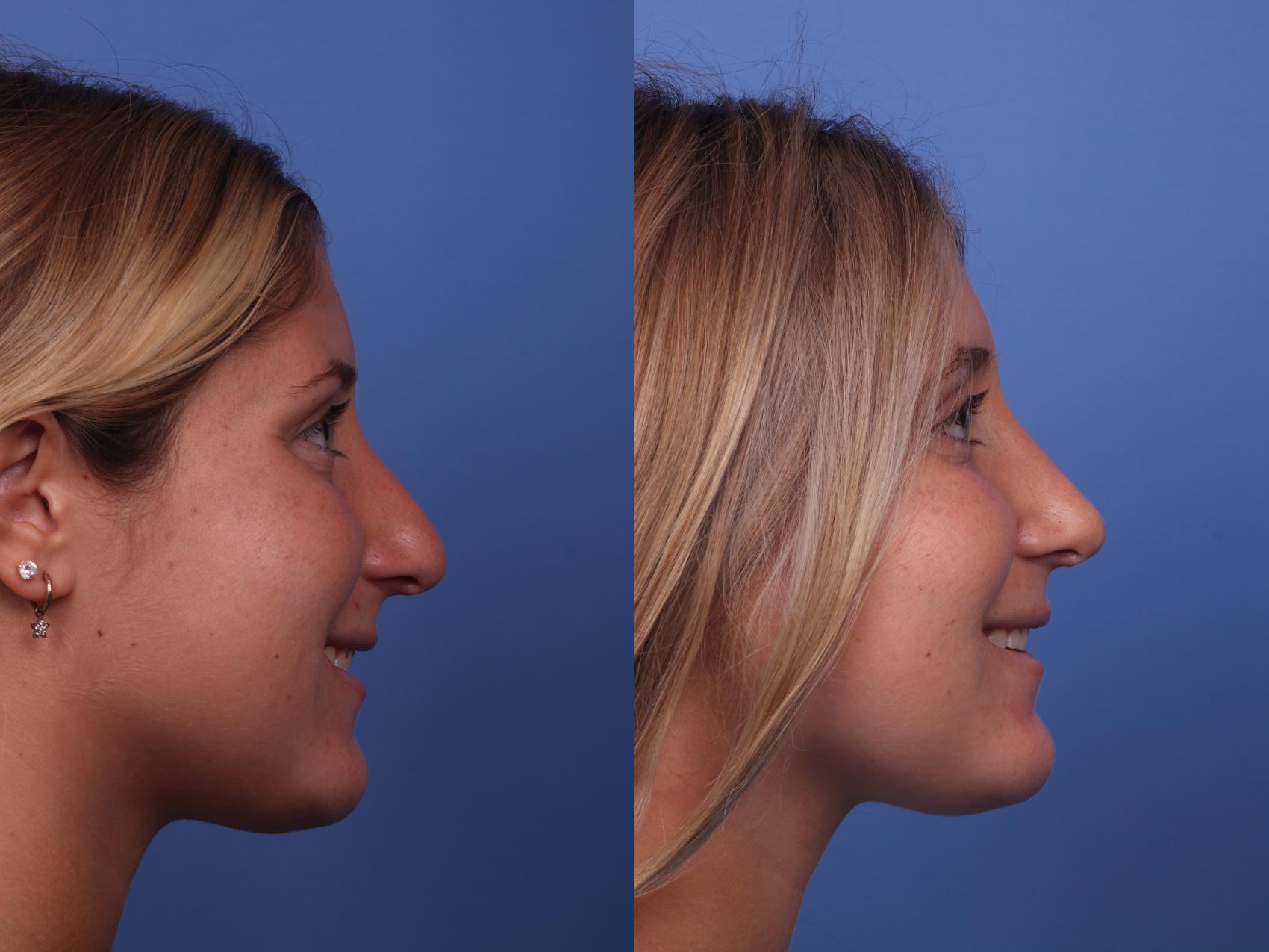 Before & After Rhinoplasty Case 398 Right Smile View in Scottsdale, AZ