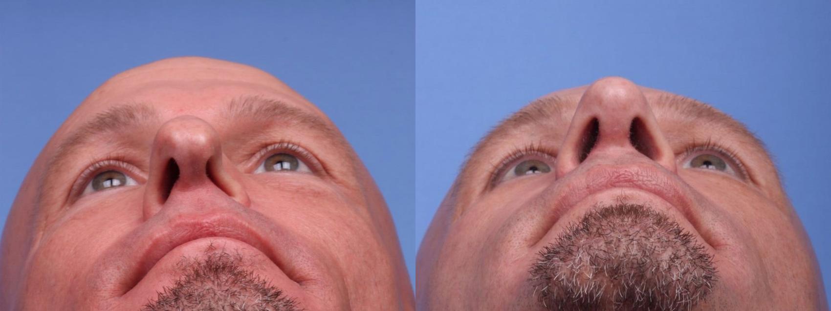 Before & After Rhinoplasty Case 40 View #2 View in Scottsdale, AZ