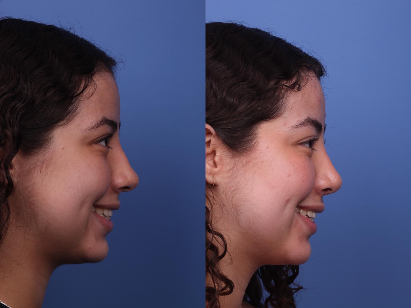 Before & After Rhinoplasty Case 400 Right Smile View in Scottsdale, AZ