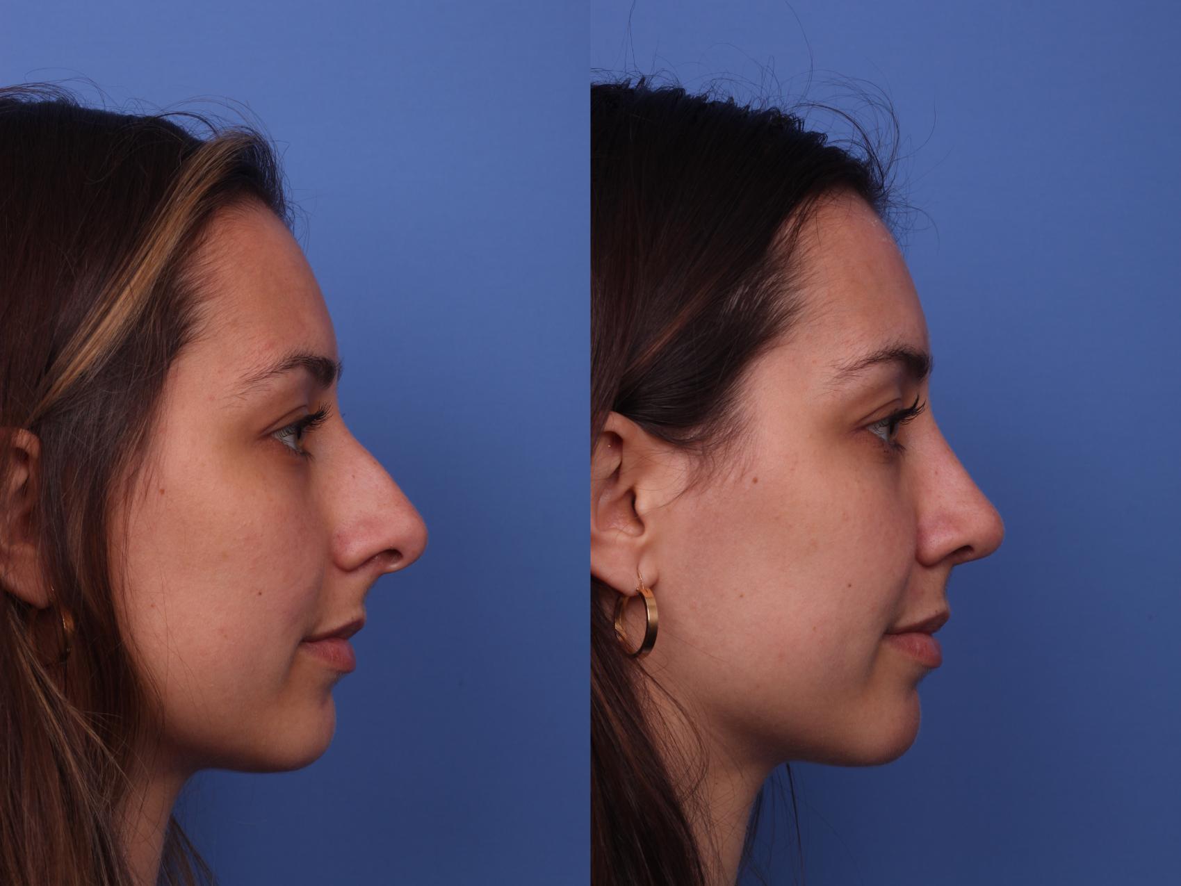 Before & After Rhinoplasty Case 401 Right Side View in Scottsdale, AZ
