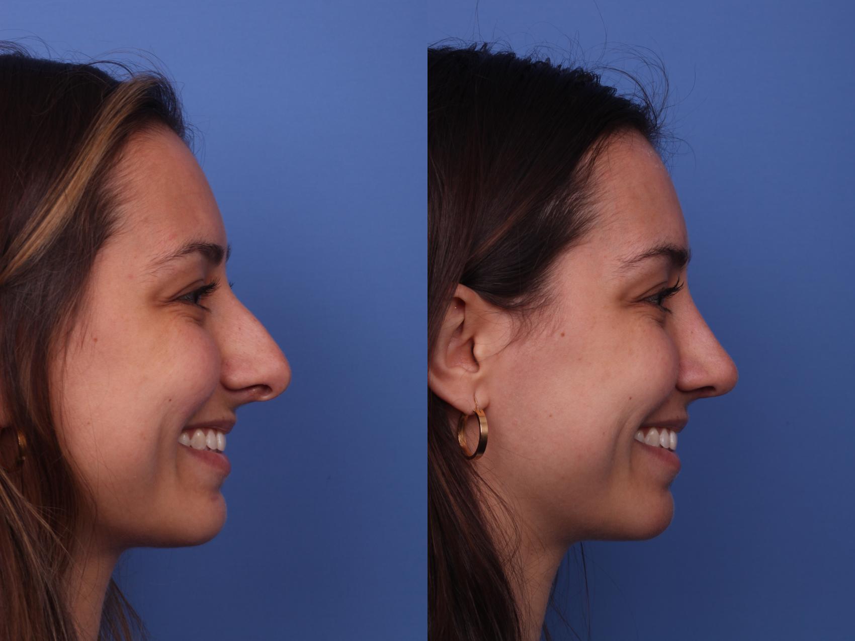 Before & After Rhinoplasty Case 401 Right Smile View in Scottsdale, AZ