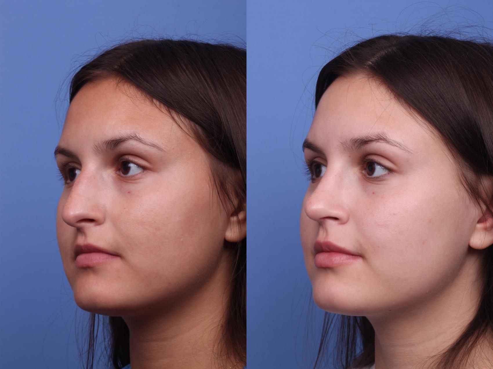 Before & After Rhinoplasty Case 402 Left Oblique View in Scottsdale, AZ