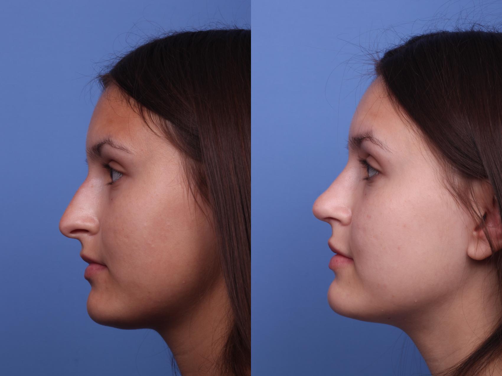 Before & After Rhinoplasty Case 402 Left Side View in Scottsdale, AZ