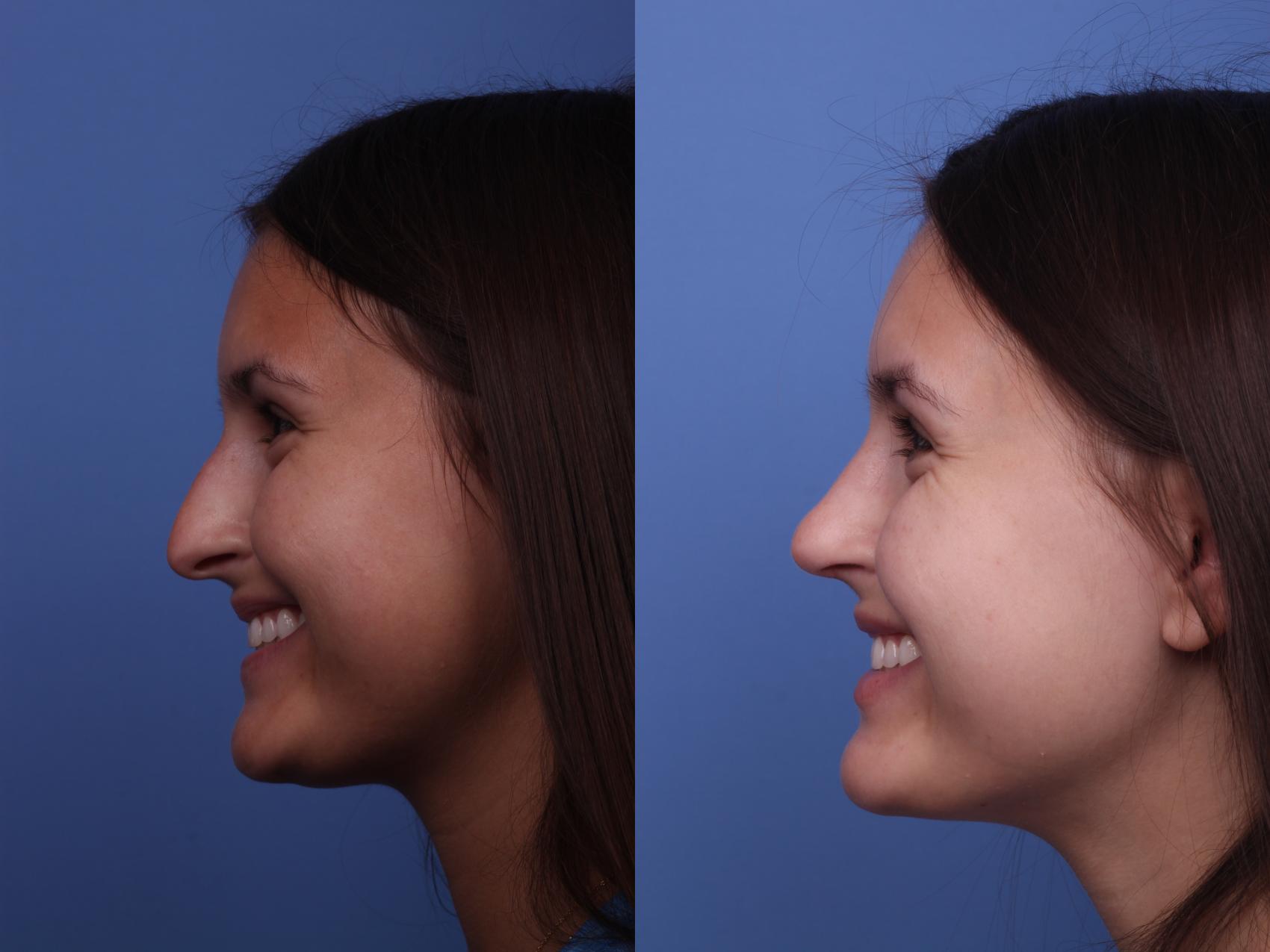 Before & After Rhinoplasty Case 402 Left Smile View in Scottsdale, AZ