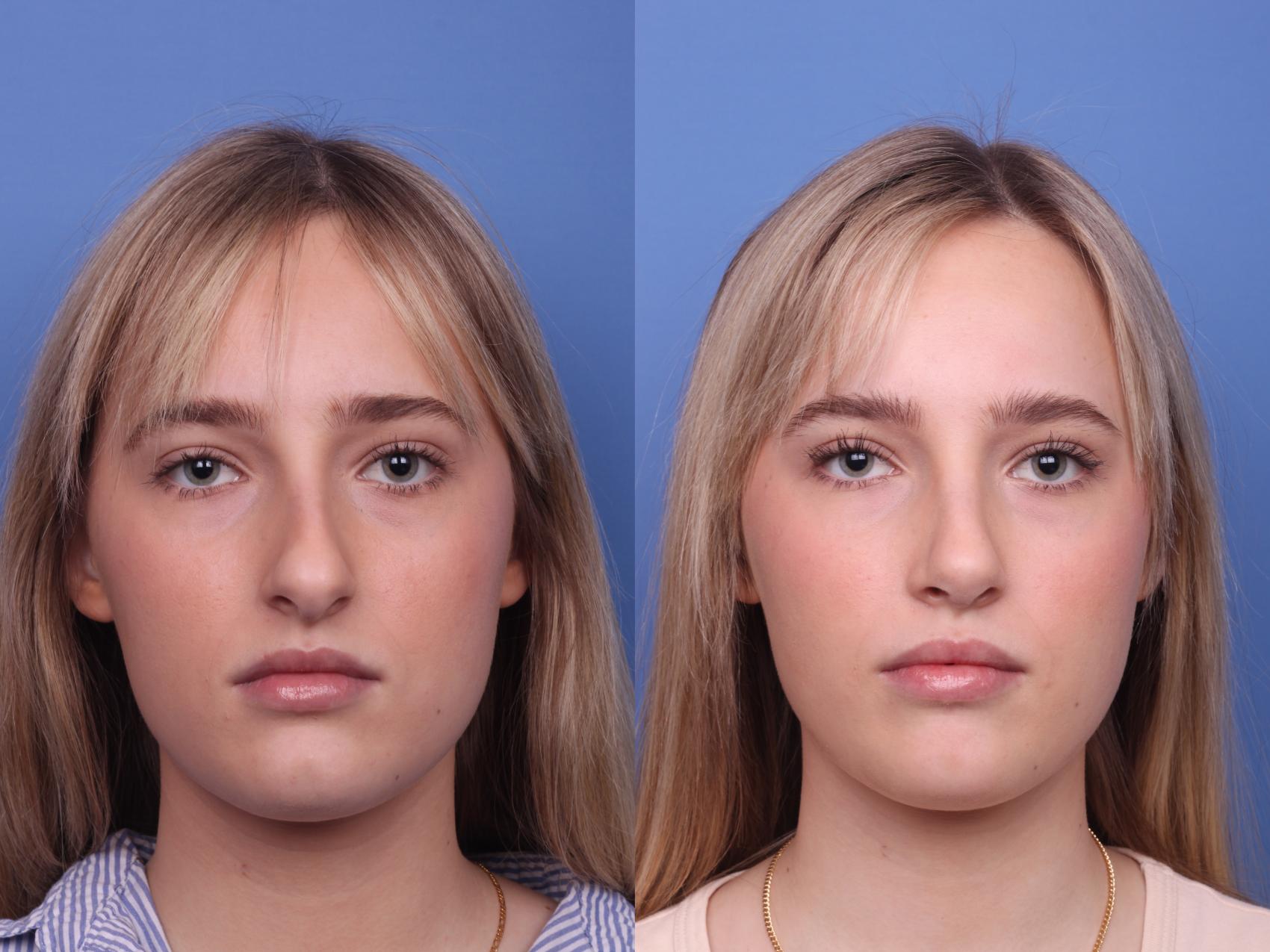 Before & After Rhinoplasty Case 404 Front View in Scottsdale, AZ