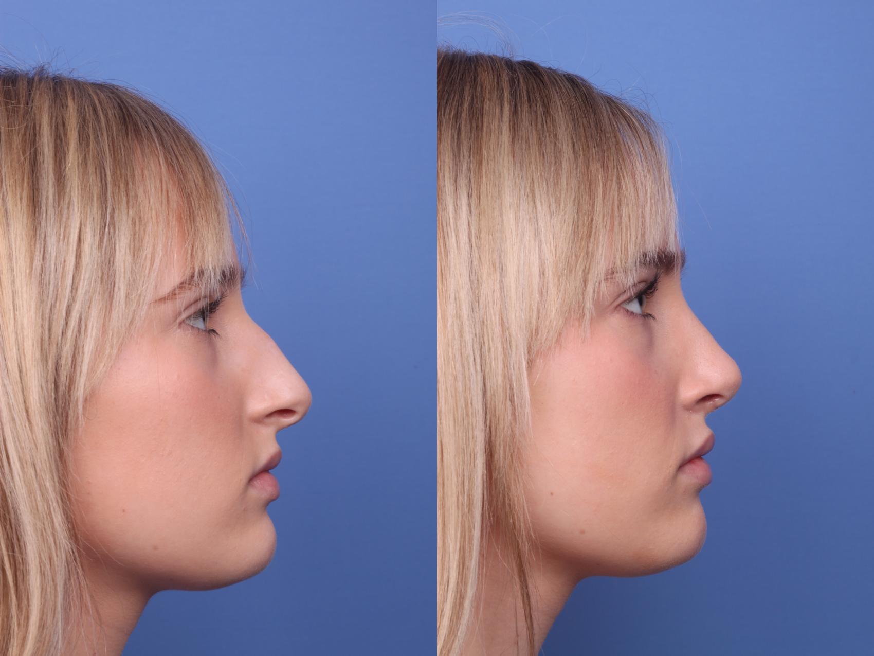Before & After Rhinoplasty Case 404 Right Side View in Scottsdale, AZ