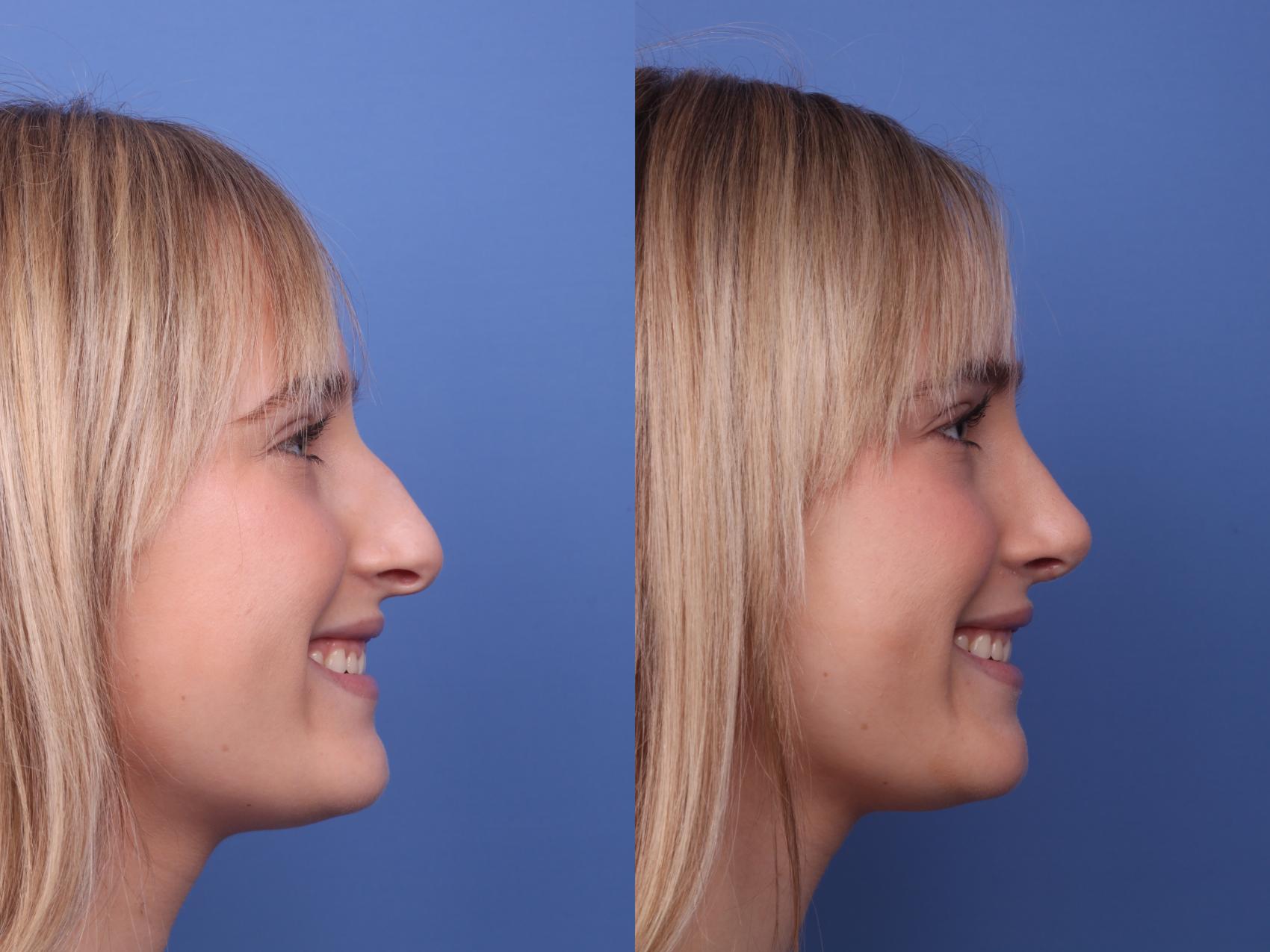 Before & After Rhinoplasty Case 404 Right Smile View in Scottsdale, AZ