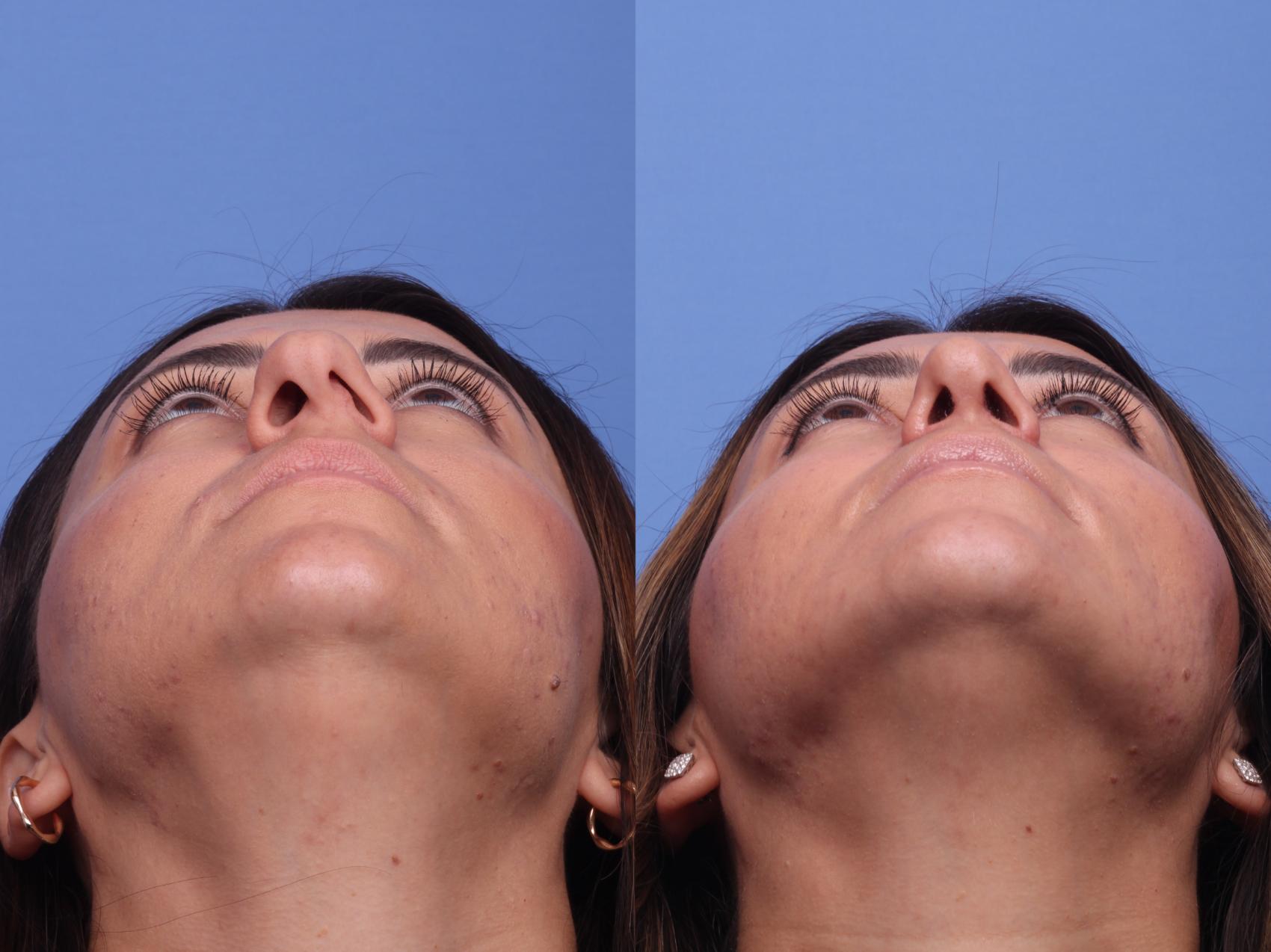Before & After Rhinoplasty Case 405 Base View in Scottsdale, AZ
