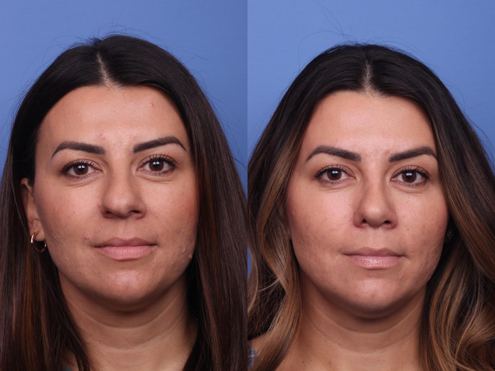 Before & After Rhinoplasty Case 405 Front View in Scottsdale, AZ