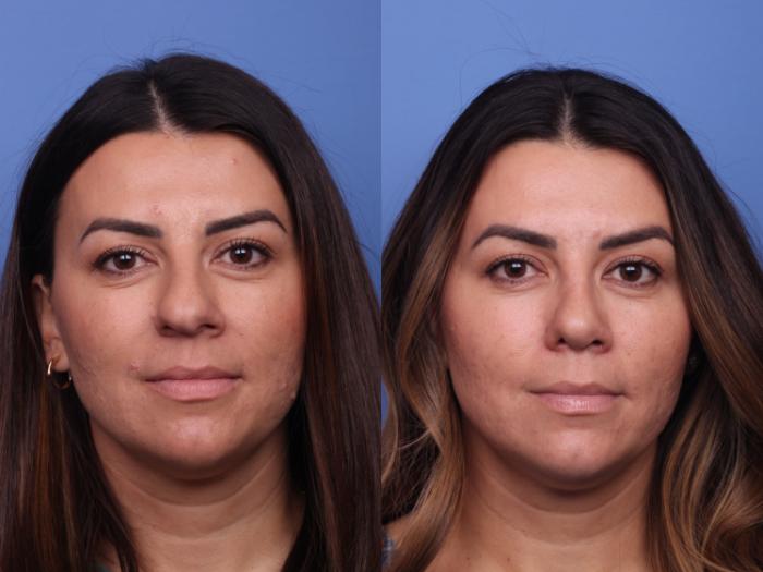 Rhinoplasty Before & After Photo | Scottsdale & Phoenix, AZ | Hobgood Facial Plastic Surgery: Todd Hobgood, MD