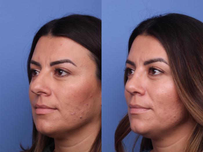 Rhinoplasty Before & After Photo | Scottsdale & Phoenix, AZ | Hobgood Facial Plastic Surgery: Todd Hobgood, MD