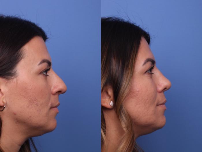 Rhinoplasty Before & After Photo | Scottsdale & Phoenix, AZ | Hobgood Facial Plastic Surgery: Todd Hobgood, MD