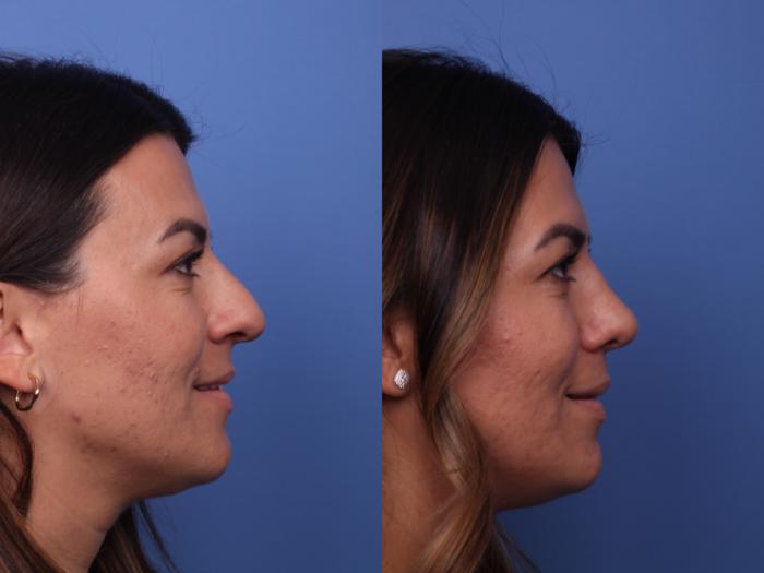 Rhinoplasty Before & After Photo | Scottsdale & Phoenix, AZ | Hobgood Facial Plastic Surgery: Todd Hobgood, MD