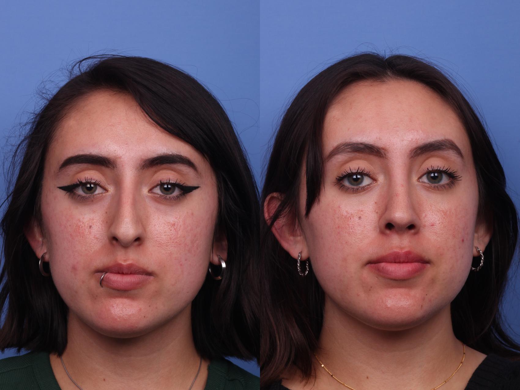 Before & After Rhinoplasty Case 407 Front View in Scottsdale, AZ