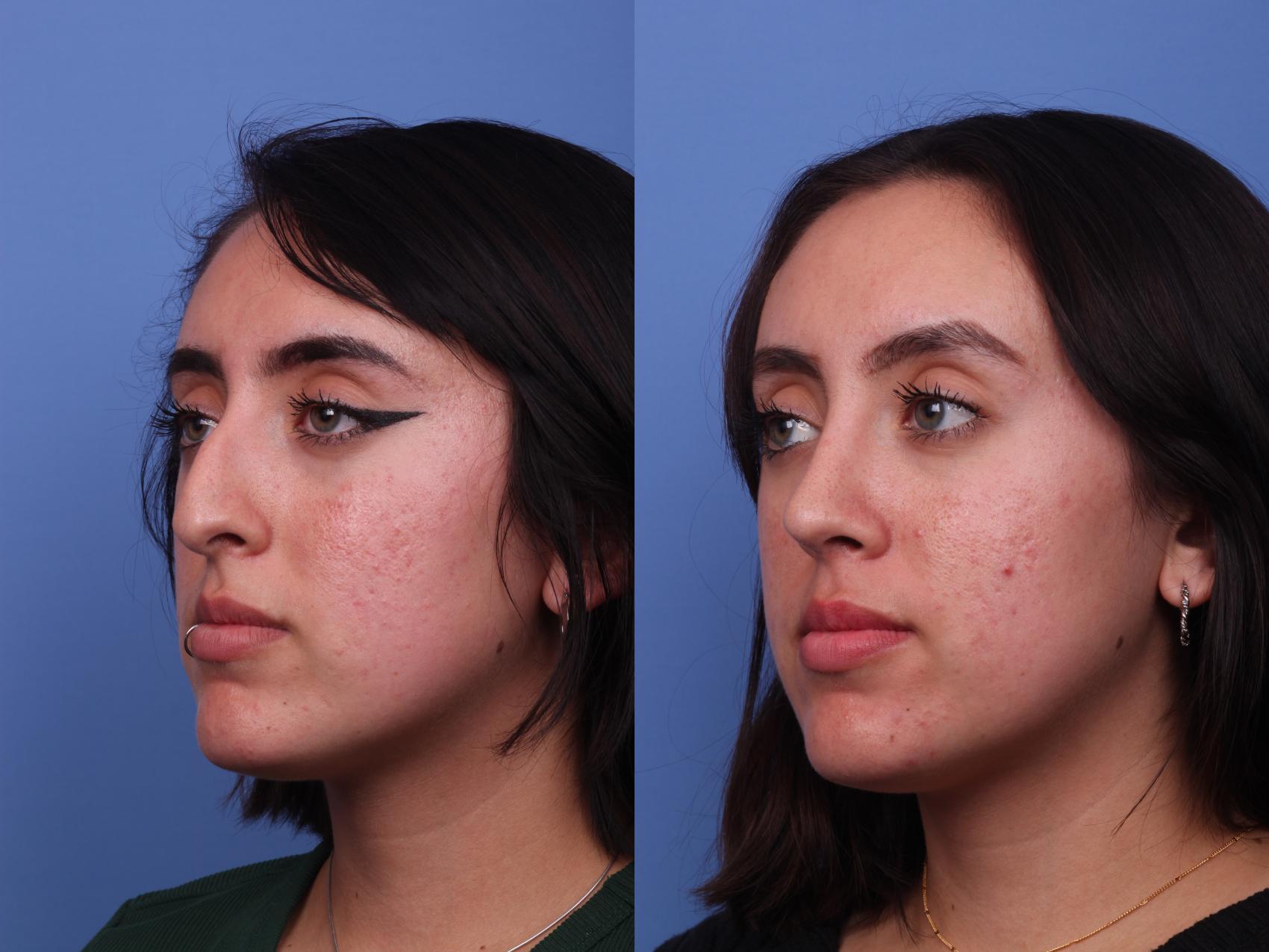 Before & After Rhinoplasty Case 407 Left Oblique View in Scottsdale, AZ
