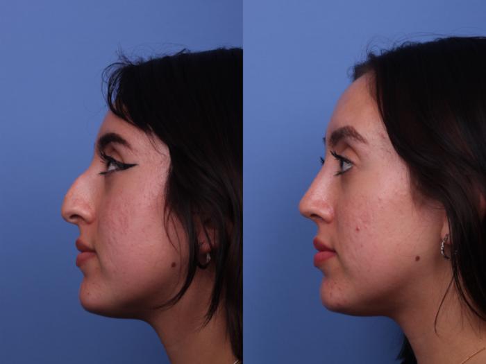 Rhinoplasty Before & After Photo | Scottsdale & Phoenix, AZ | Hobgood Facial Plastic Surgery: Todd Hobgood, MD