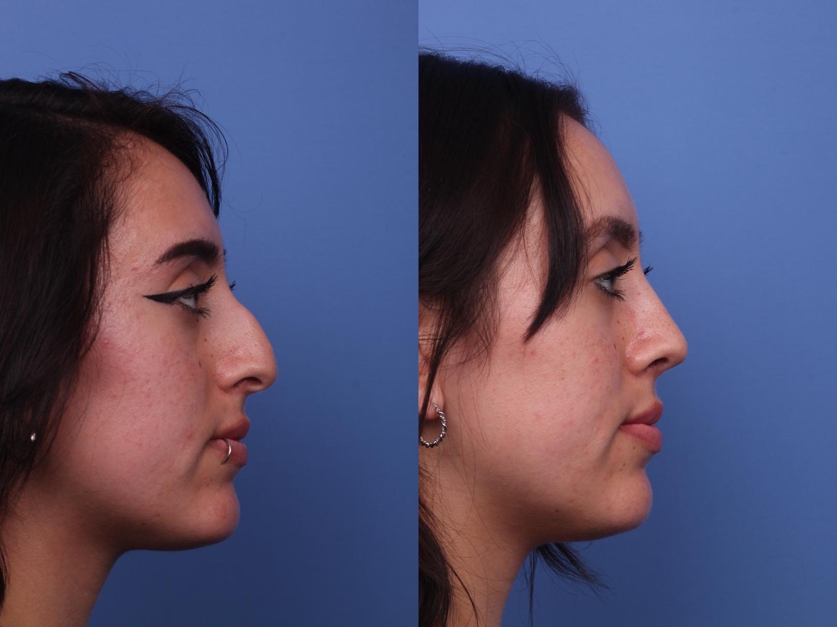Before & After Rhinoplasty Case 407 Right Side View in Scottsdale, AZ