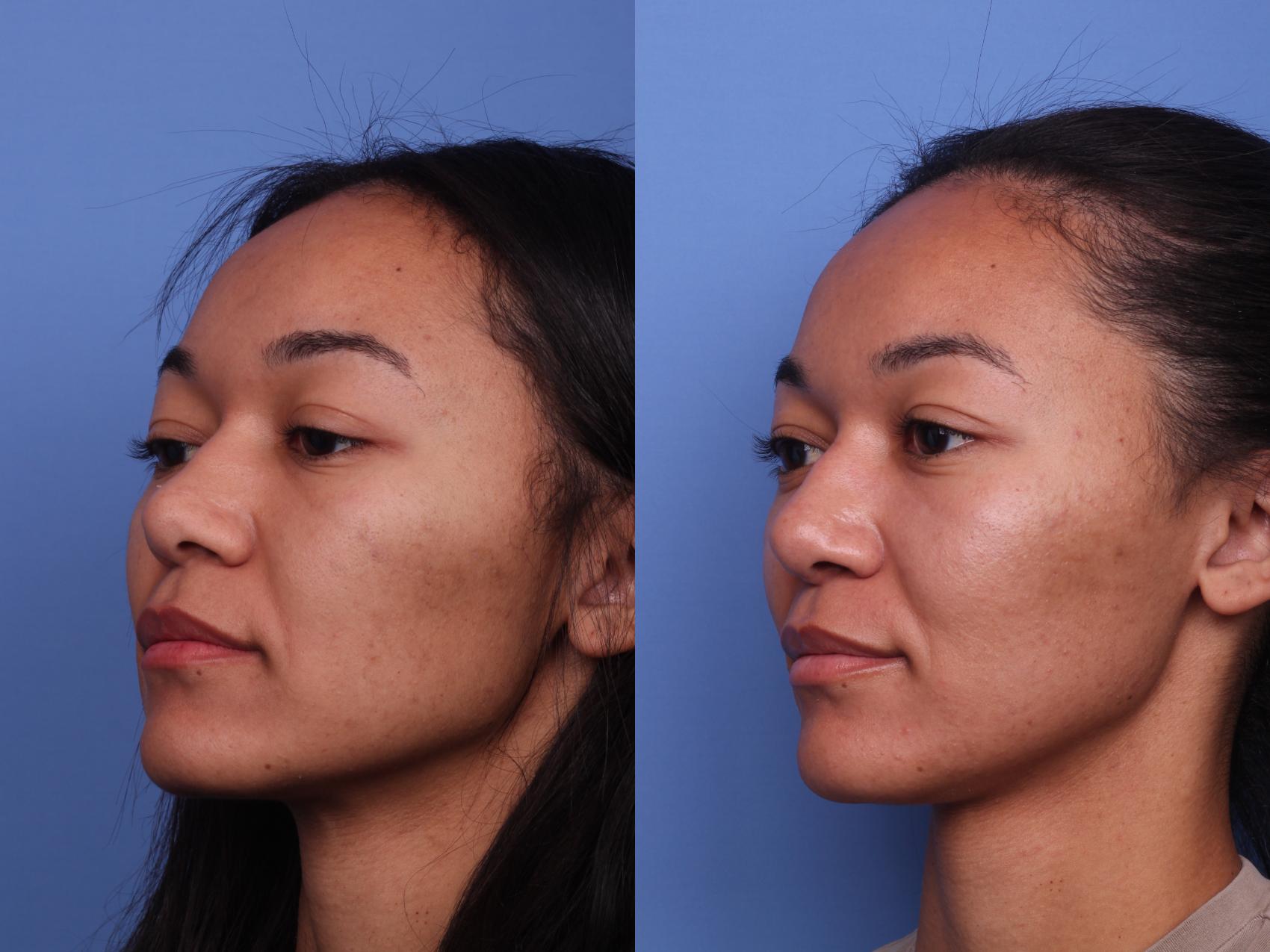 Before & After Ethnic Rhinoplasty Case 408 Left Oblique View in Scottsdale, AZ