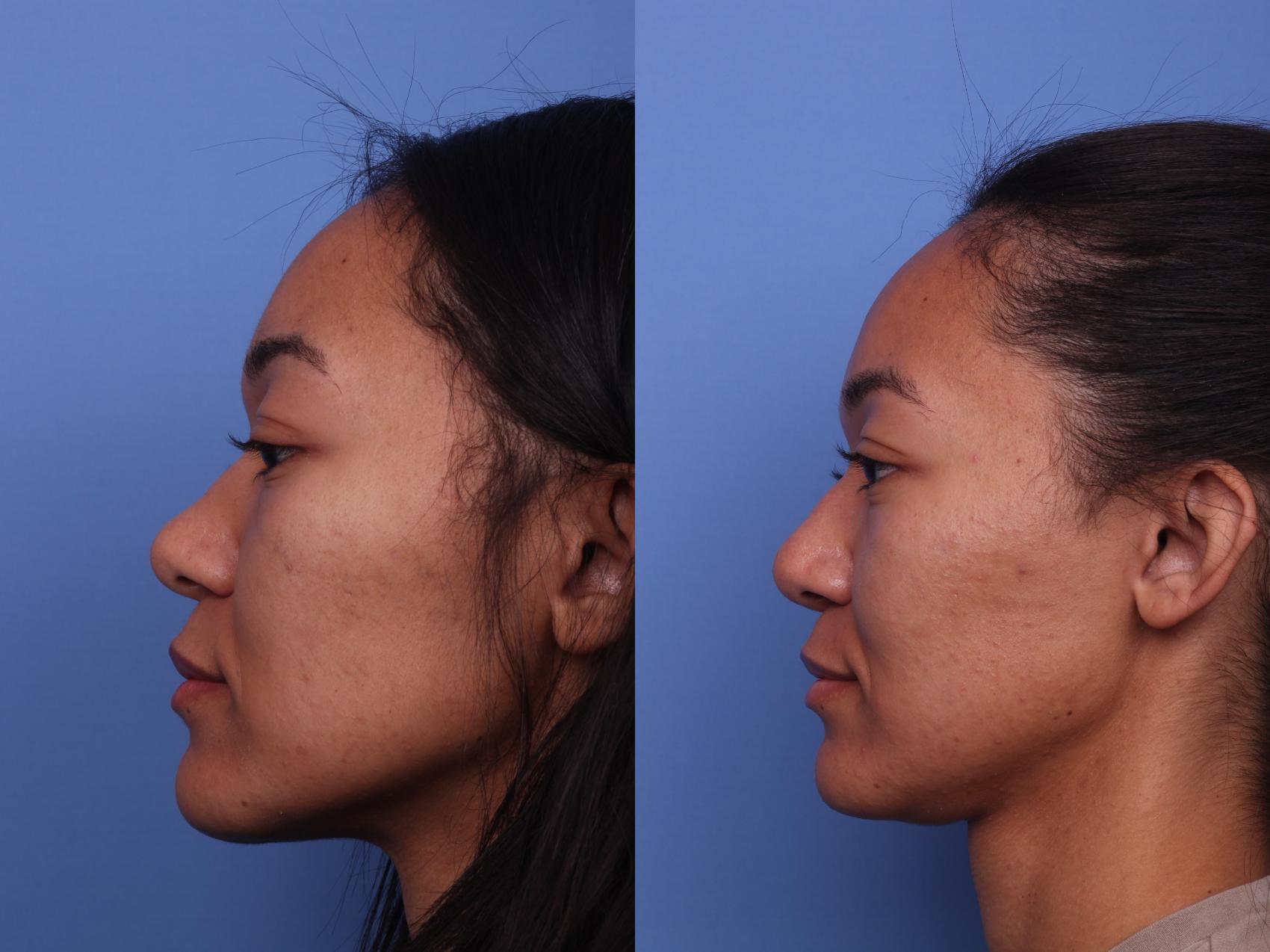 Before & After Ethnic Rhinoplasty Case 408 Left Side View in Scottsdale, AZ