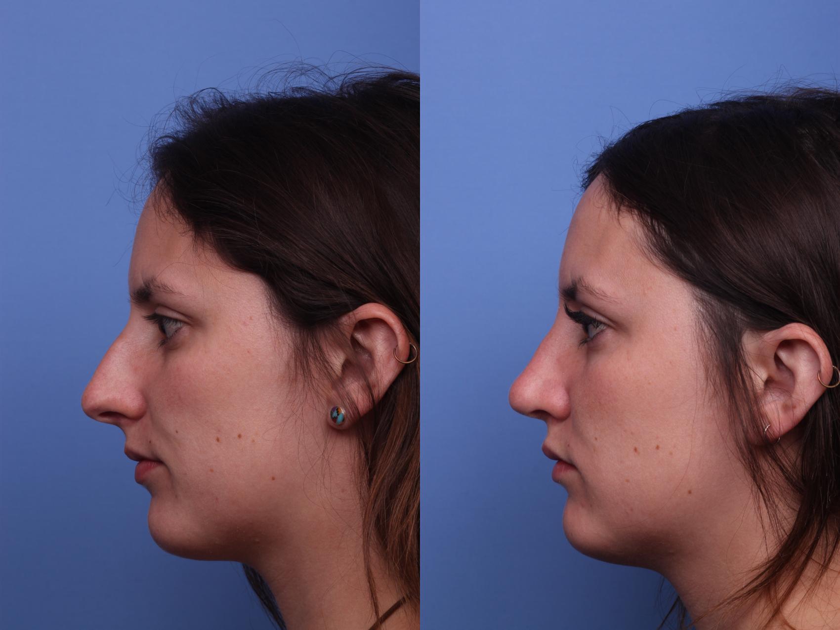 Before & After Rhinoplasty Case 409 Left Side View in Scottsdale, AZ
