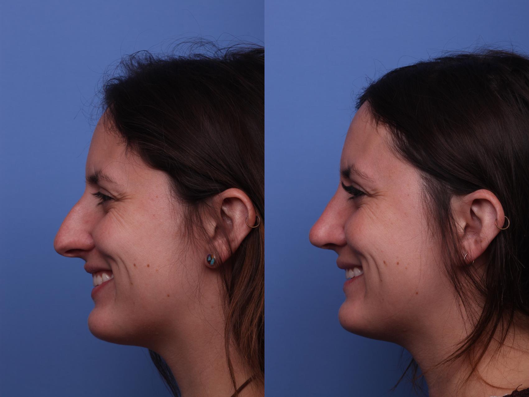 Before & After Rhinoplasty Case 409 Left Smile View in Scottsdale, AZ
