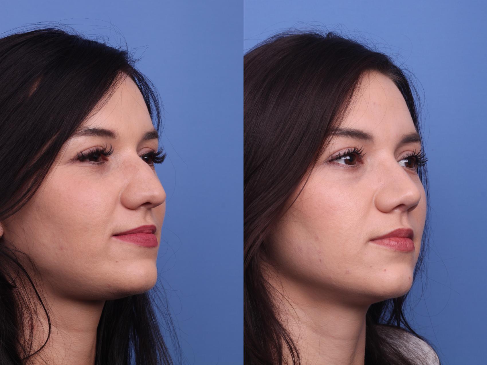Before & After Rhinoplasty Case 412 Right Oblique View in Scottsdale, AZ