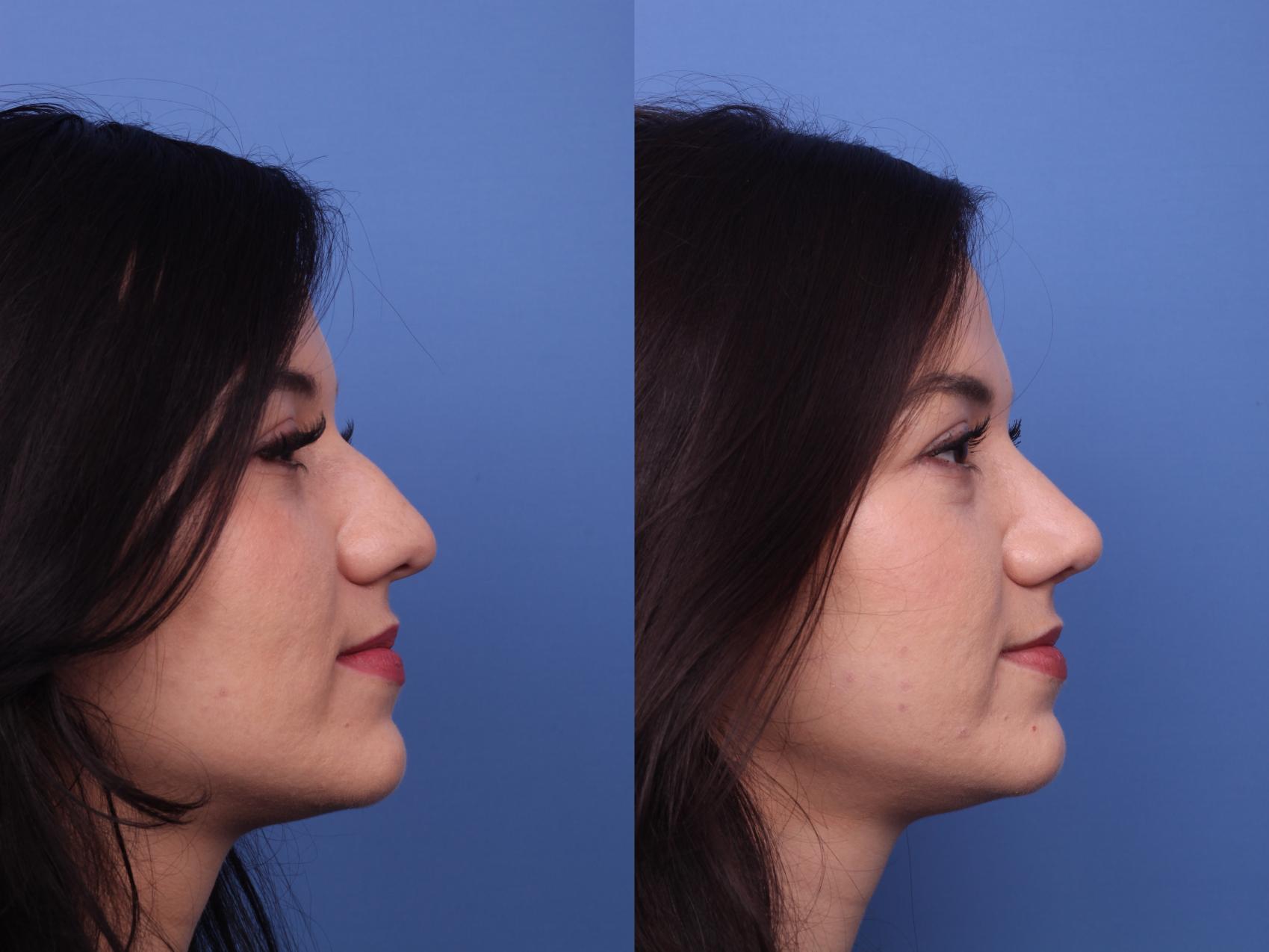 Before & After Rhinoplasty Case 412 Right Side View in Scottsdale, AZ